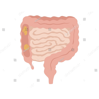 Illustration of the large bowel showing tumours in the wall of the colon.