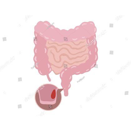 Illustration of the large bowel with a cross-section of the anal canal showing a haemorrhoid.